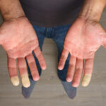 sindrome-raynaud